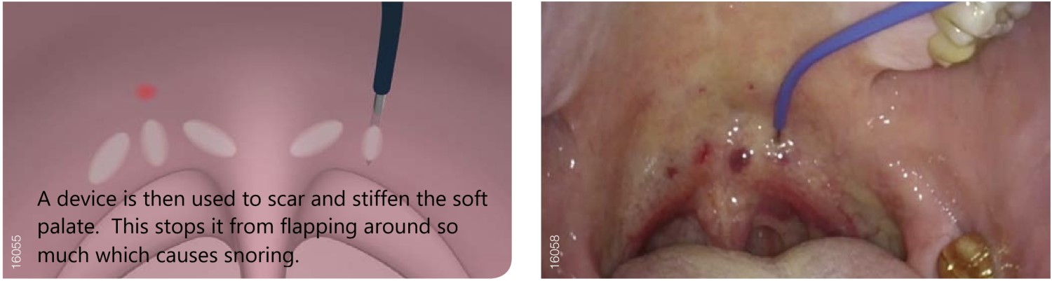 stiffening of the palate using radiofrequency ablation under local anaesthetic a snoring operation
