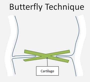 tympanic perforation butterfly tympanoplasty repair