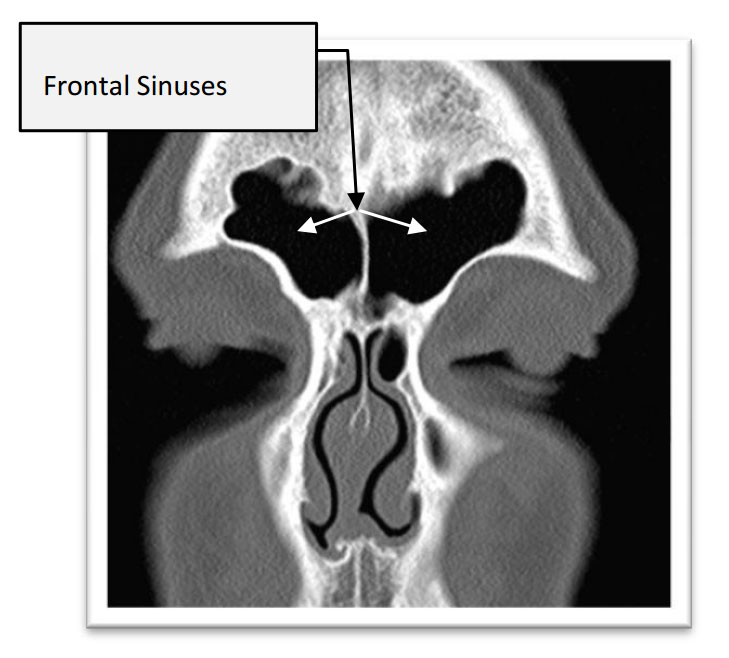 frontal sinuses
