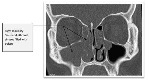 CT scan of nasal polyps