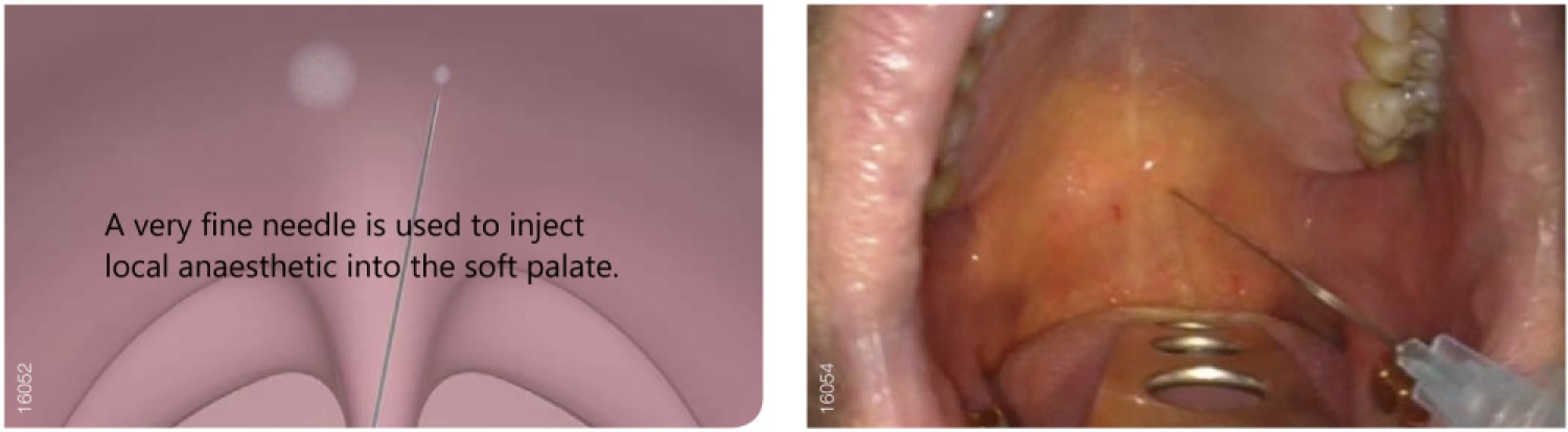 stiffening of the palate using radiofrequency ablation under local anaesthetic a snoring operation