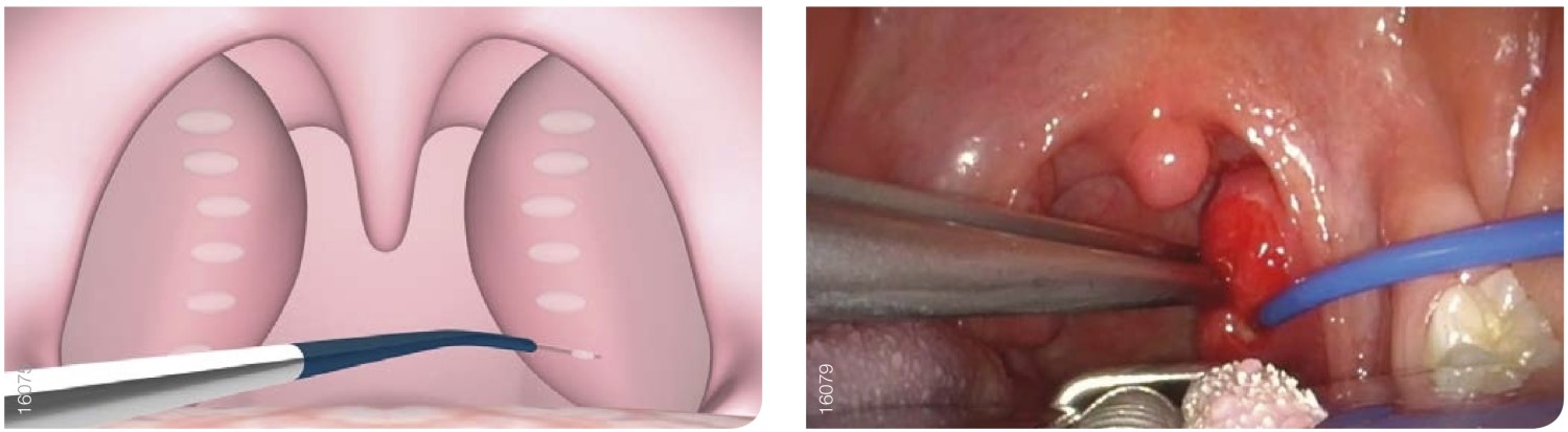 reduction of tonsils using radiofrequency ablation under local anaesthetic
