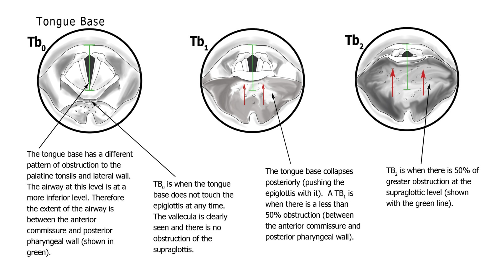 PTLTbE classification — Tb (Tongue base) level: Tb0 normal with vallecula visible, Tb1 less than 50% obstruction, Tb2 50% or more