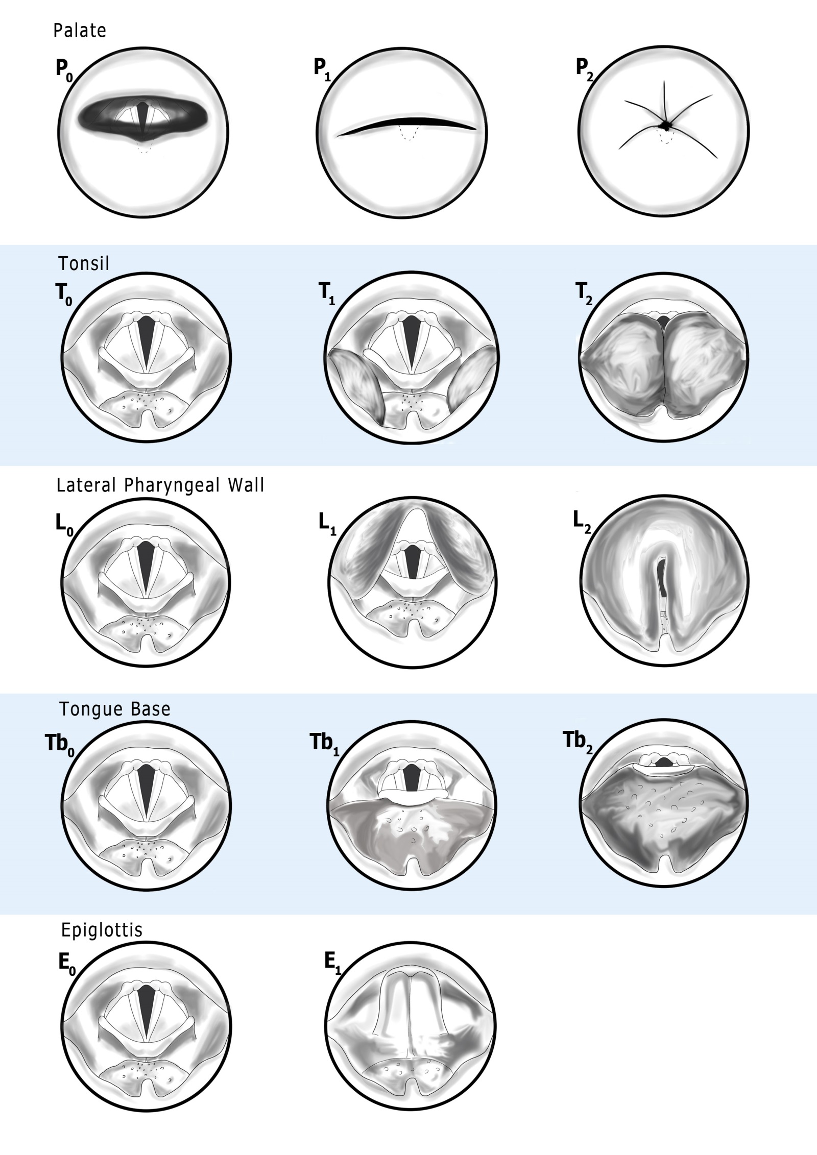 PTLTbE complete visual guide — all five levels (Palate, Tonsil, Lateral wall, Tongue base, Epiglottis) with grading 0, 1, and 2